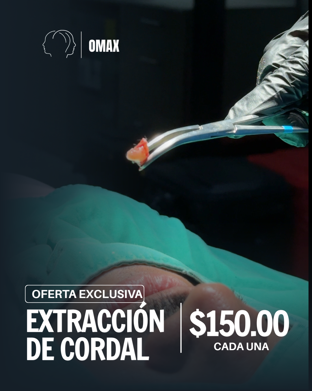 Extracción de cordales
