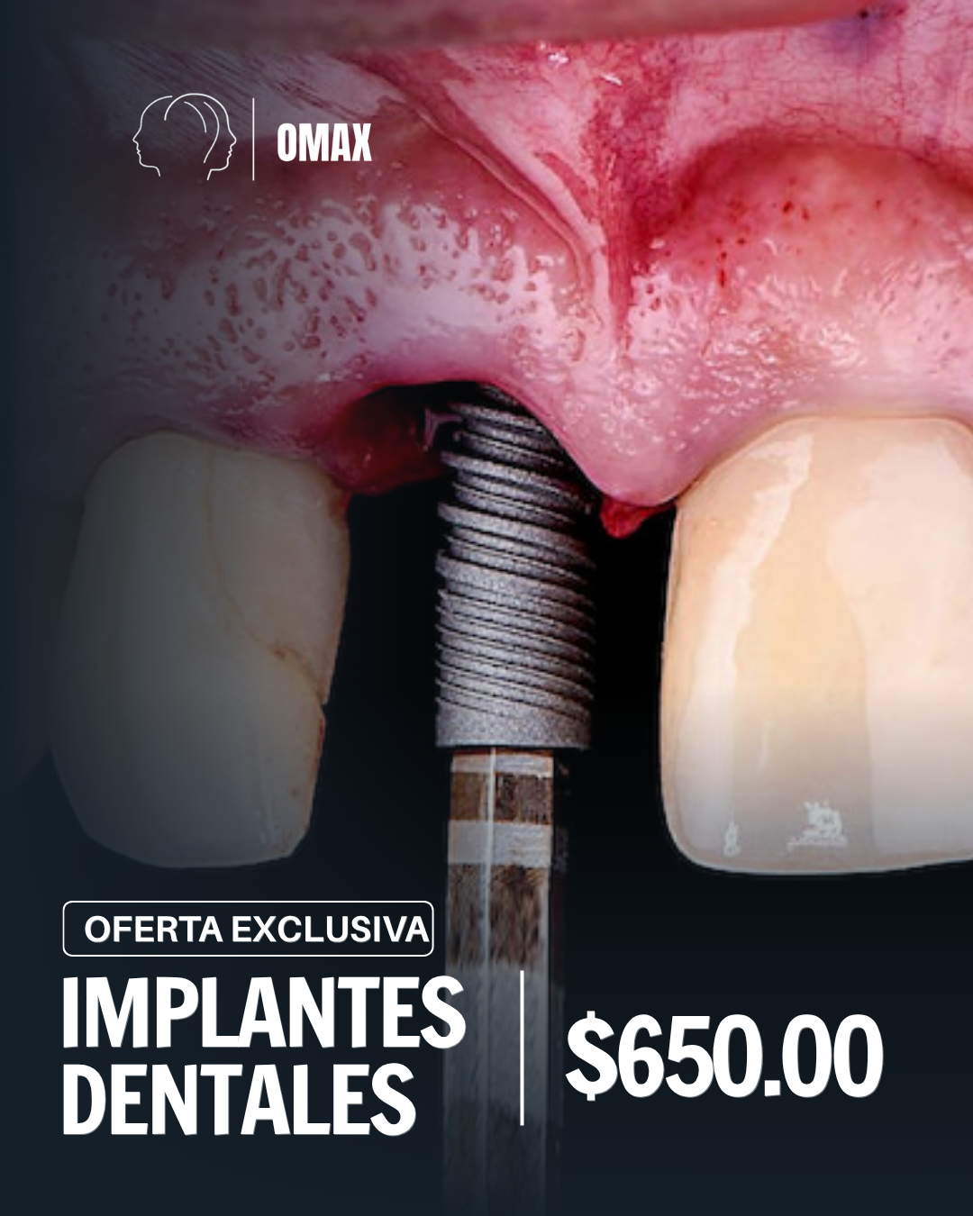 Implantes dentales
