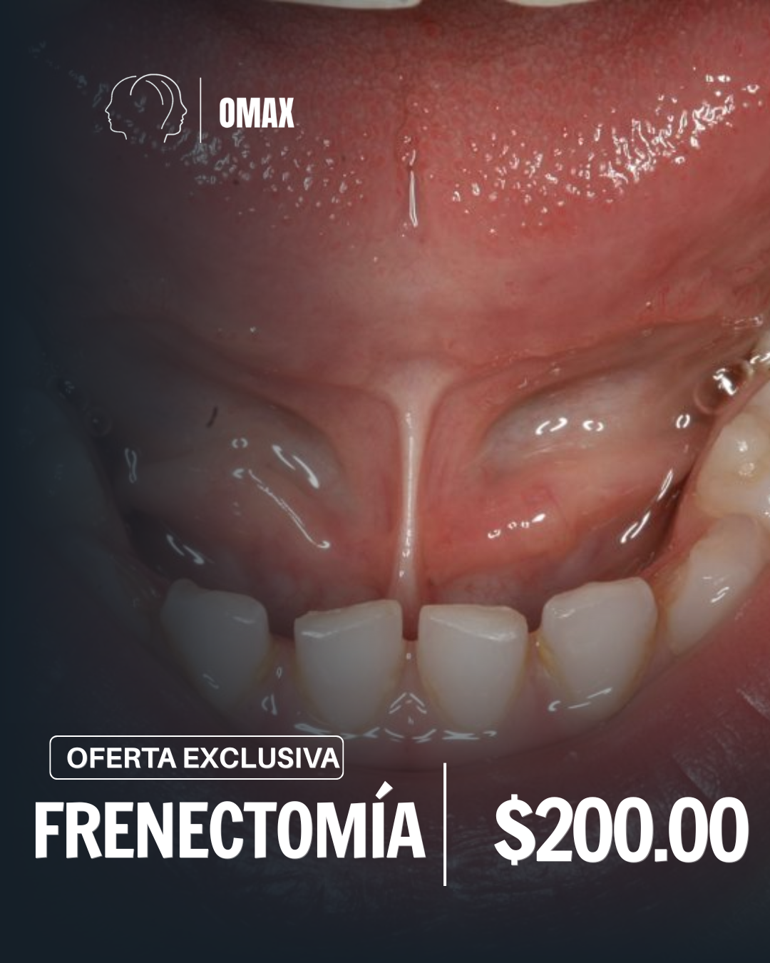 Frenectomía